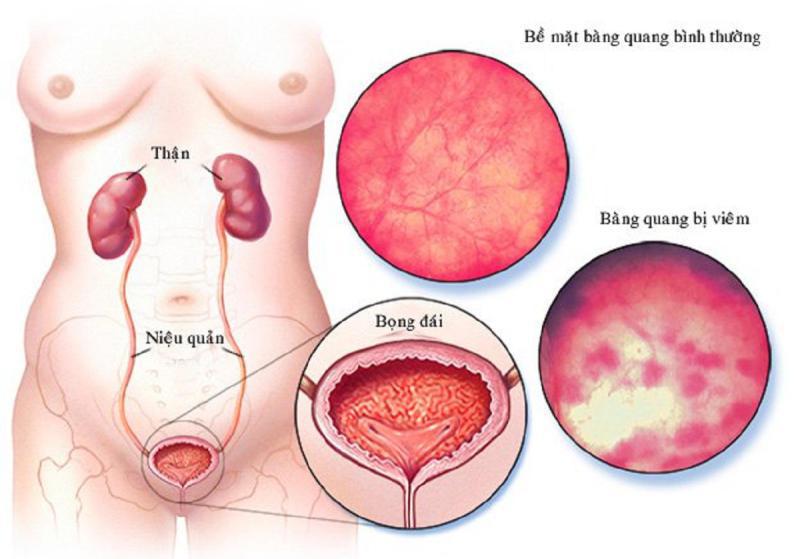 cách chữa viêm đường tiết niệu ở nam giới