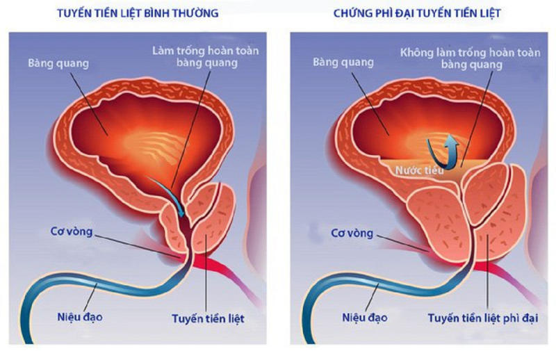 đi tiểu ra máu tươi ở phụ nữ