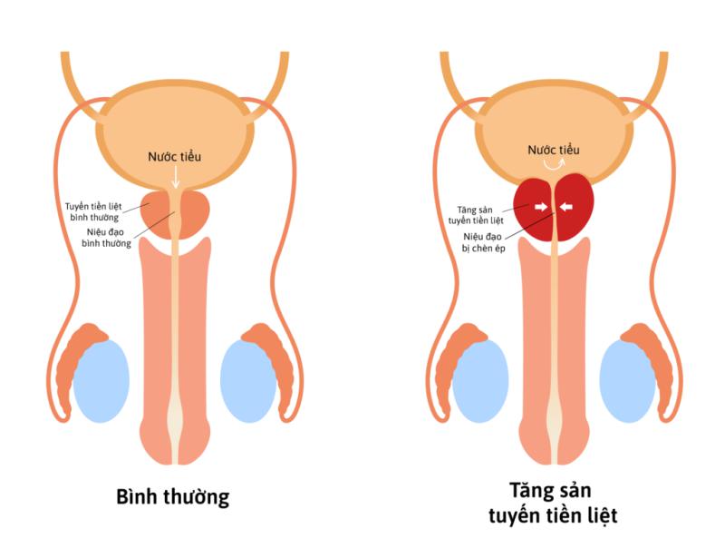 Đi tiểu ra máu nhưng không đau