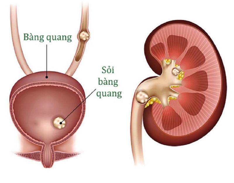 Đi tiểu ra máu nhưng không đau