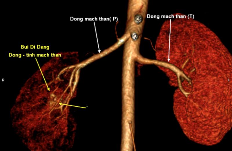 	
triệu chứng đi tiểu ra máu ở nam giới