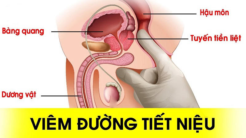 Nhiễm trùng đường tiết niệu