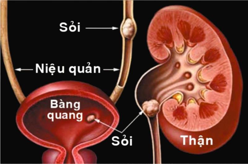 sỏi đường tiết niệu