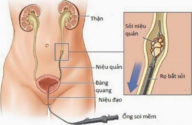 sỏi tiết niệu