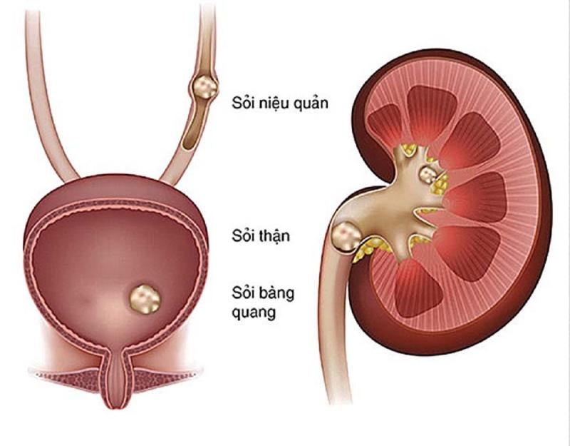 sỏi tiết niệu