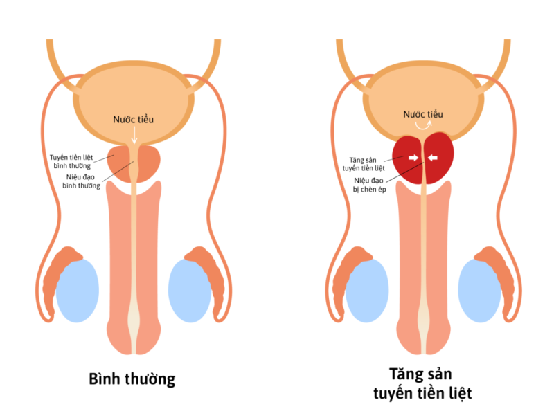 tiểu ra máu có nguy hiểm không