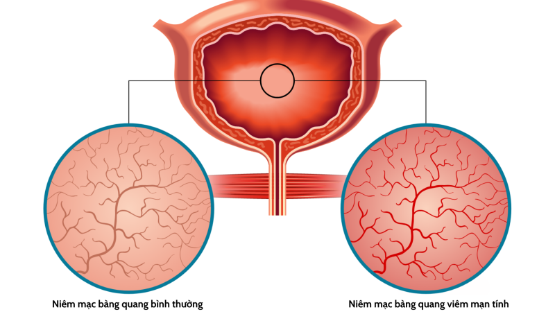 tiểu ra máu có nguy hiểm không