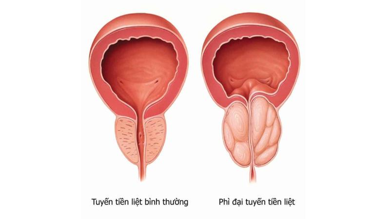 đi tiểu buốt ra máu khám ở đâu