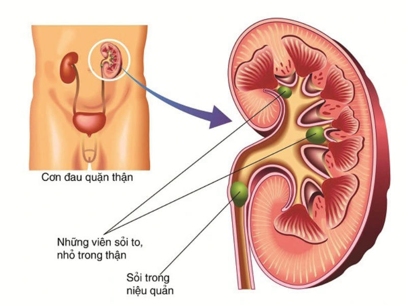 bệnh viêm đường tiết niệu có tự khỏi được không