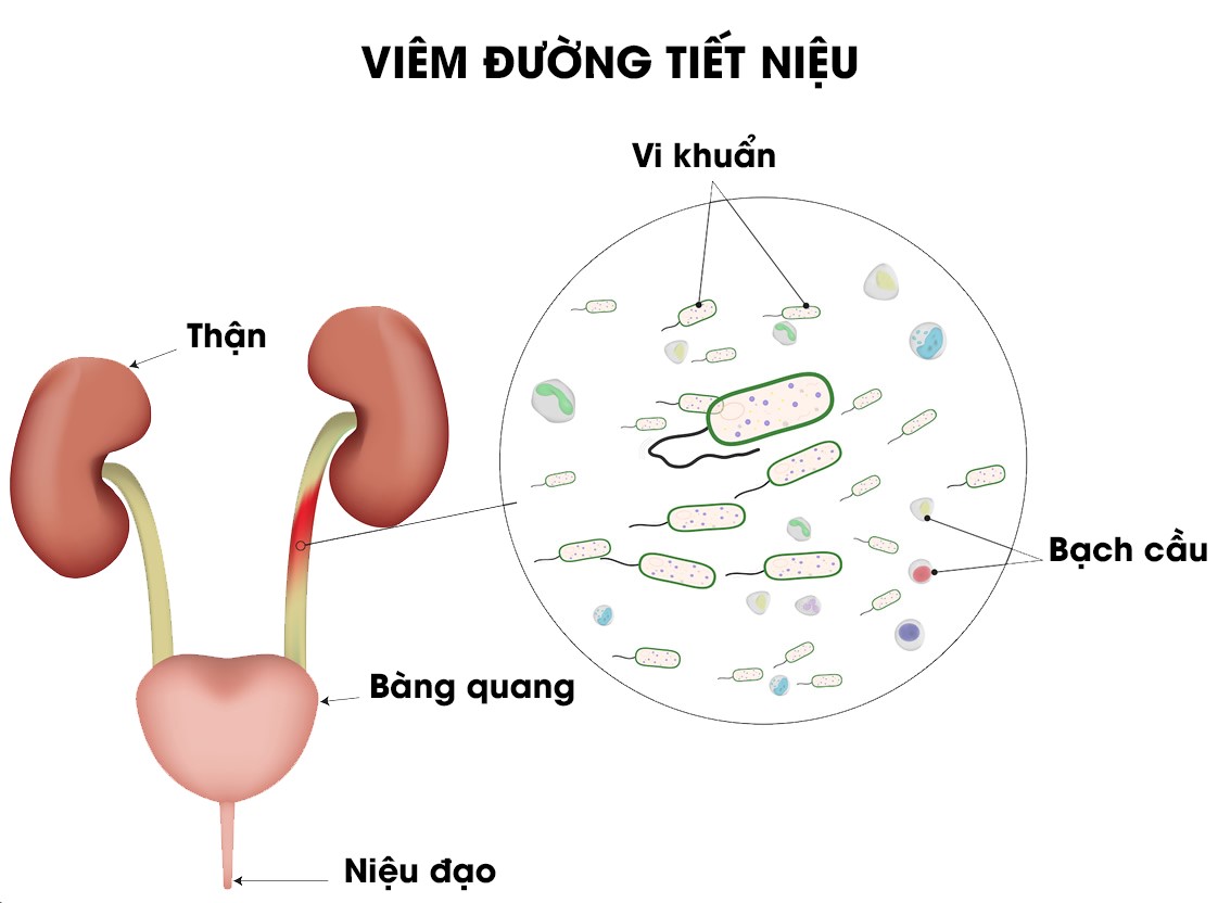 Viêm đường tiết niệu gây đi tiểu ra máu