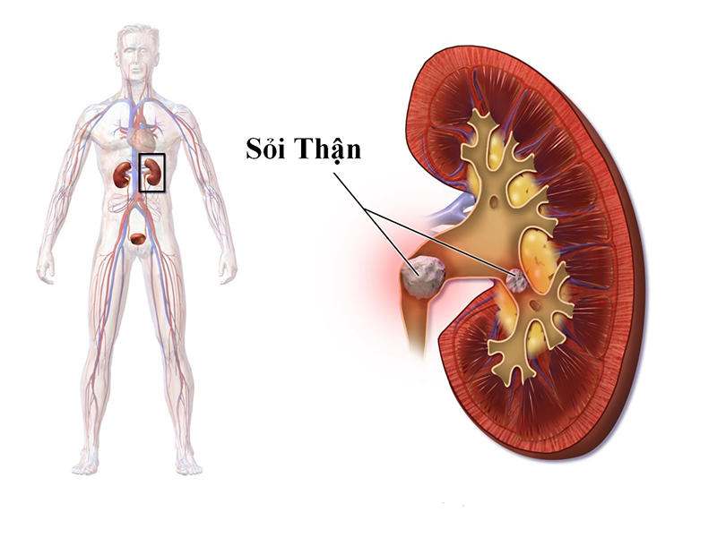 chăm sóc người bệnh sỏi đường tiết niệu