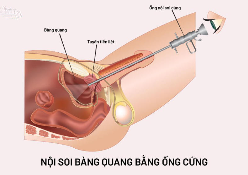 nội soi bàng quang