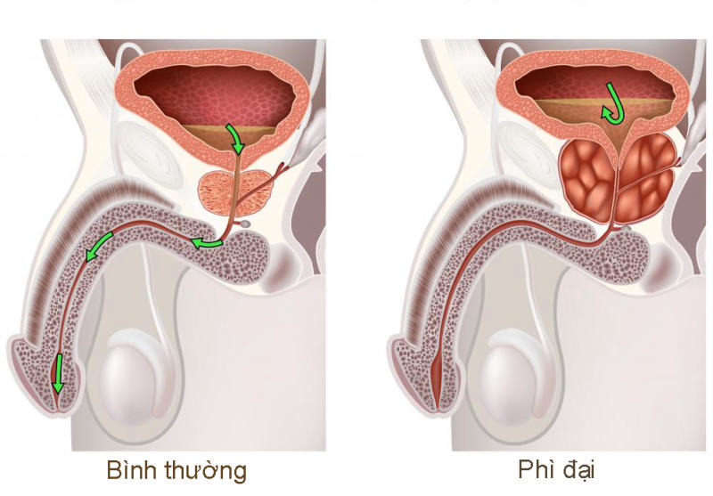 phì đại tiền liệt tuyến