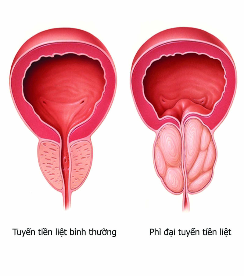 phì đại tiền liệt tuyến