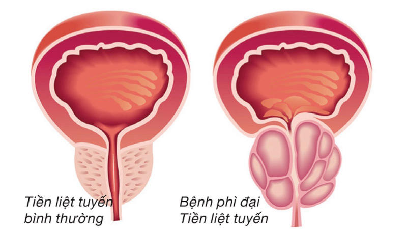 u xơ tiền liệt tuyến