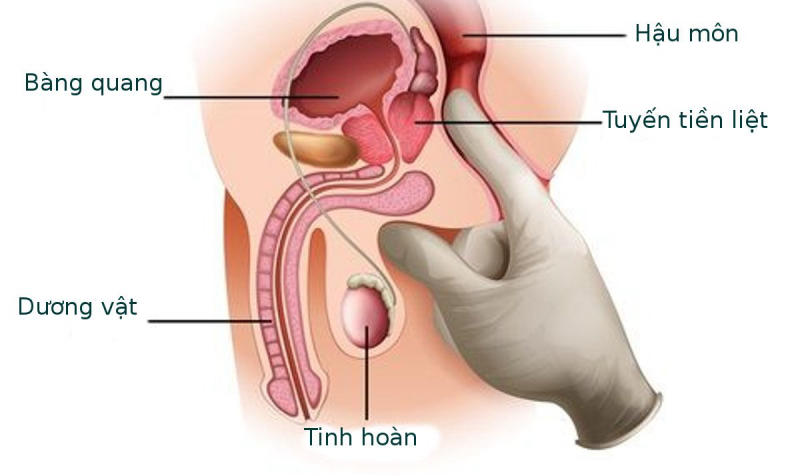 ung thư tuyến tiền liệt