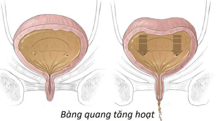 bàng quang tăng hoạt