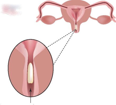 đặt thuốc viêm phụ khoa bị chảy máu