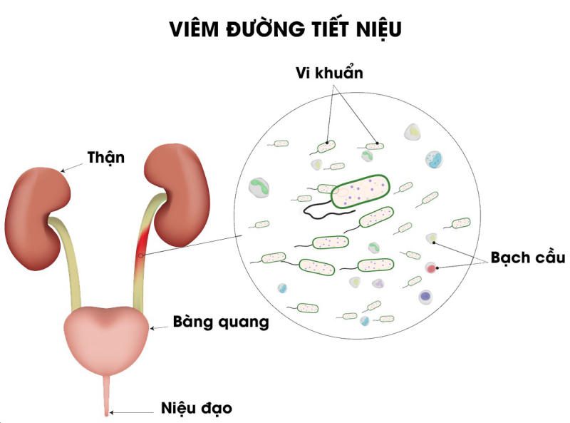 sỏi thận xuống bàng quang