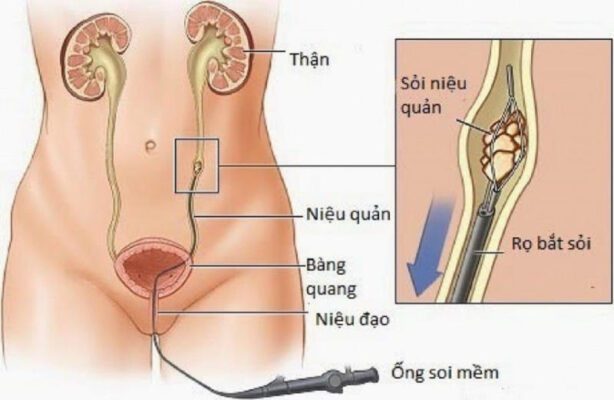 tán sỏi bàng quang
