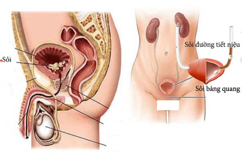 tán sỏi bàng quang