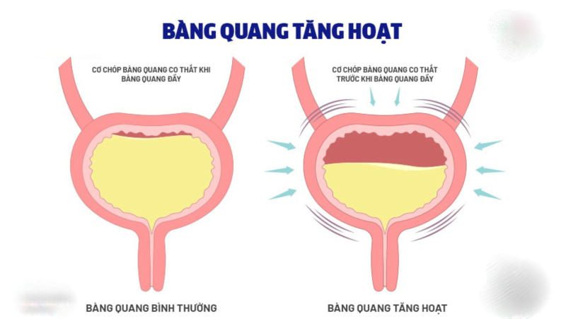 thuốc đặc trị bàng quang kích thích