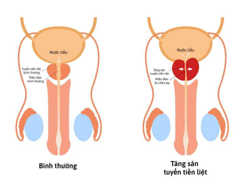 tiền liệt tuyến