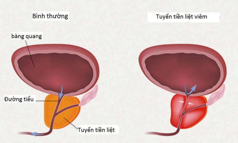 tiền liệt tuyến