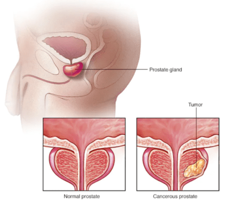 tiền liệt tuyến