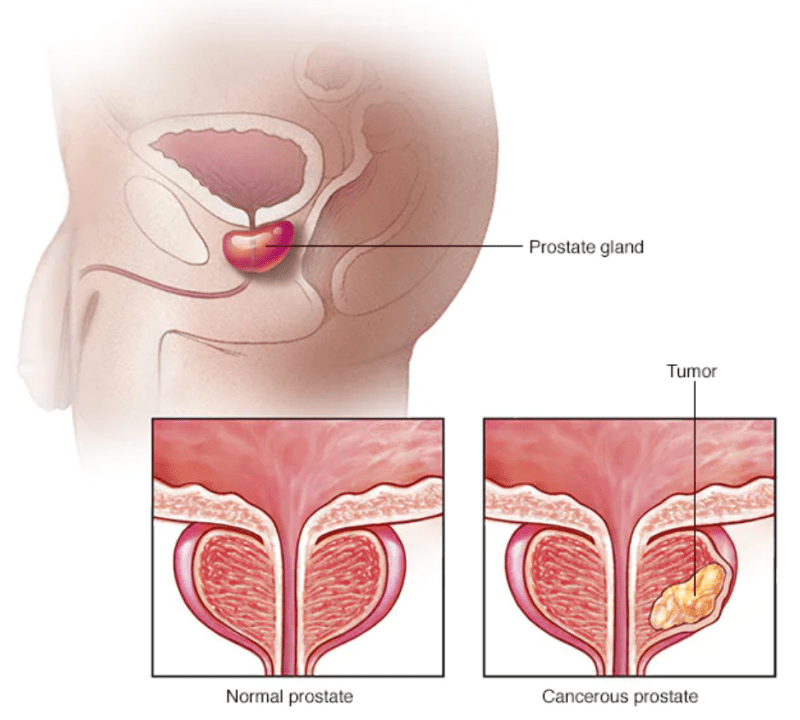 tiền liệt tuyến