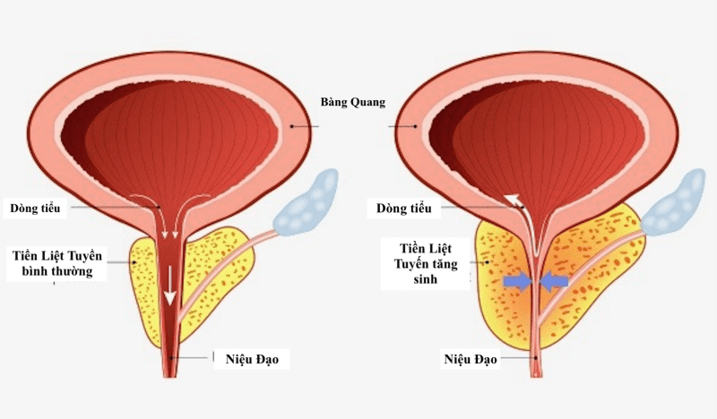 tuyến tiền liệt nằm ở đâu