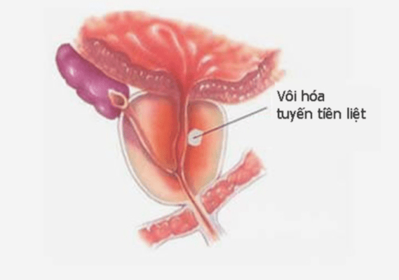vôi hóa tiền liệt tuyến